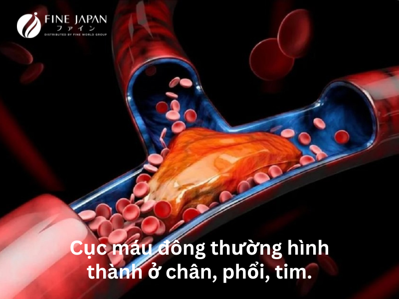 Cục máu đông: nguyên nhân, triệu chứng và cách ngăn ngừa
