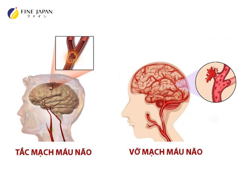 Tắc mạch máu não: Dấu hiệu, nguyên nhân, và phòng ngừa
