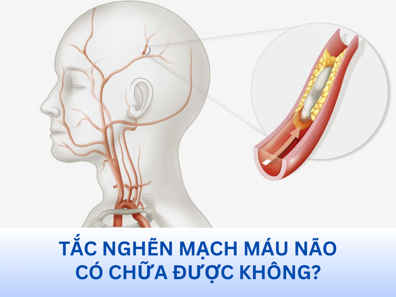 Tắc nghẽn mạch máu não có chữa được không?