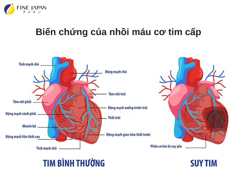Nhồi Máu Cơ Tim Cấp: Dấu Hiệu và Cách Phòng Ngừa